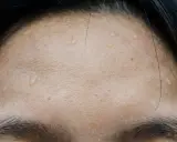 Gouttes de sueur sur le front, signe de transpiration excessive du visage après un effort.