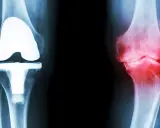 Röntgenbilder av knän: ett med protes, ett med inflammation. Ger rekommendationer efter kortisoninjektion.