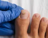 Main d'un podologue examinant un ongle de pied atteint de mycose. Renseignez-vous sur le tarif podologue mycose pour un traitement.