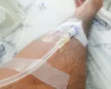 Ręka z założonym cewnikiem dializacyjnym, widoczna jest taśma medyczna i fragment pościeli szpitalnej. Pielęgnacja cewnika dializacyjnego jest kluczowa.