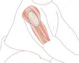Illustration av en arm med markerad muskel där det kan kännas ont i armen efter tbe vaccination.