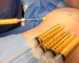 Lipofilling seno: pro e contro. Siringhe piene di grasso aspirato pronte per il rimodellamento del seno.