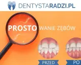 Proste licówki na krzywe zęby. Porównanie uśmiechu przed i po zabiegu.