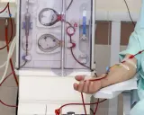 Dializator to urządzenie do prowadzenia terapii oczyszczającej krew. Pacjent podłączony do maszyny, widoczna jego ręka z kaniulą i czerwonymi przewodami.