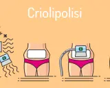 Illustrazione della criolipolisi: il processo, i benefici e i possibili criolipolisi effetti collaterali.
