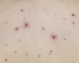 Skóra z licznymi, czerwonymi krostkami i grudkami. To mogą być ospa początki, zwiastujące chorobę.