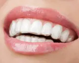 Zbliżenie na usta z widocznym aparatem Invisalign. Przezroczyste nakładki dyskretnie korygują zgryz, zapewniając piękny uśmiech.
