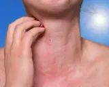 Une personne se gratte le cou rouge et irrité, peut-être à cause de boutons de soleil sur le visage et le corps. Le soleil brille intensément en arrière-plan.