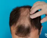 Main d'un médecin examinant une perte de cheveux. Une solution pour la perte de cheveux due à la thyroïde.