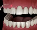 Zabieg gingiwektomii laserem: precyzyjne modelowanie dziąseł dla pięknego uśmiechu.