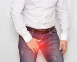 Mężczyzna w białej koszuli i dżinsach, z ręką na kroczu, gdzie widoczny jest czerwony obszar bólu, sugerujący żylaki powrózka nasiennego.