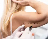 Medico disegna con pennarello su braccio, segnando una nuova tecnica per lifting braccia.