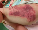 Grossa macchia violacea sulla coscia di un neonato, simile a punture di medusa (quallenstich punkte).