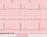 EKG z zapisem rytmu zatokowego. Widoczne są fale serca z zaznaczonymi odstępami R-R >1.5s, wskazującymi na bradykardię.