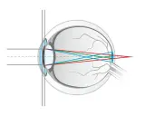 Schéma de l'œil montrant la réfraction des rayons lumineux rouge, vert et bleu. La lumière bleue est plus déviée, illustrant qu'est ce que la lumière bleue.