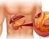 Ilustracja anatomiczna przedstawiająca trzustkę z guzem nowotworowym.