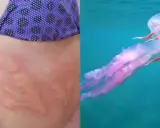Pelle arrossata con segni di una **piqûre meduse** e una medusa rosa trasparente che nuota nell'acqua blu.