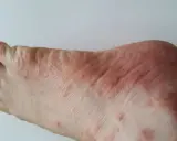 Pieds présentant des rougeurs et des petits boutons qui grattent, signe d'une irritation cutanée.