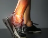 Anatomia skręconej kostki z widocznymi kośćmi i zapaleniem.
