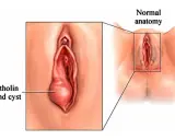 Ilustracja pokazuje zapalenie gruczołu Bartholina jako powiększoną torbiel po lewej stronie, w porównaniu do prawidłowej anatomii po prawej.