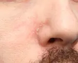 Pelle arrossata e desquamata intorno al naso, sintomo di dermatite seborroica.