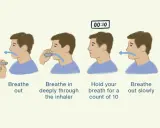 Schritt-für-Schritt-Anleitung zur Pulmicort Anwendung: Inhalator öffnen, ausatmen, tief inhalieren, 10 Sekunden Luft anhalten, langsam ausatmen, Inhalator schließen.