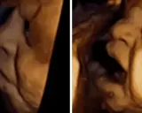 Dwa obrazy USG płodu, ukazujące jego twarz z otwartymi ustami.