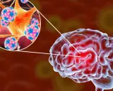 Illustration av hjärnan med en förstorad vy av virus som orsakar hjärnhinneinflammation.