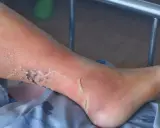 Gamba con arrossamento, desquamazione e lesioni cutanee, possibili sintomi di ulcera alle gambe.
