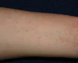 Braccio con piccoli puntini rossi, un segno di inizio scabbia. La pelle appare leggermente irritata.