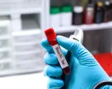 Ręka w niebieskiej rękawiczce trzyma probówkę z krwią do badania pH. Gazometria jest kluczowa w diagnostyce niewydolności nerek.