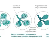 Veranschaulicht die Zerstörung von Lungenbläschen bei COPD, auch ohne Rauchen. Zeigt gesunde, erweiterte und geplatzte Lungenbläschen.