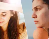 Visage protégé du soleil avec crème, puis profil avec acné et taches, une cicatrice soleil peut apparaître sans protection.