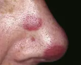 Lesioni cutanee violacee sul naso, indicative di sarcoma di Kaposi.