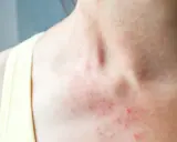 Skóra na szyi i dekolcie jest zaczerwieniona i pokryta wysypką. Może to być reakcja alergiczna, np. na nowy kosmetyk, albo objaw problemów z elocom.