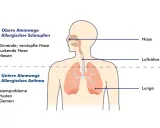Schema zeigt obere Atemwege (allergischer Schnupfen) und untere Atemwege (allergisches Asthma). So kann man allergisches Asthma behandeln.