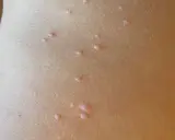 Piccolo dettaglio della pelle di un bambino con molluschi contagiosi, piccole protuberanze rosee che sembrano minuscoli molluschi.