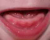 Gengive rosse e gonfie di un neonato, con piccole bollicine di saliva. Inizia la dentizione, un momento emozionante per la dentizione del neonato.