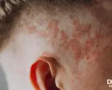Psoriasis du cuir chevelu, souvent exacerbée par le stress, se manifeste par des plaques rouges et squameuses près de l'oreille.