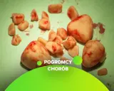 Kamień w przewodzie moczowym jak wysikać? Zobacz usunięte kamienie nerkowe, które mogą powodować ból i problemy z oddawaniem moczu.