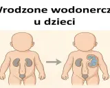 Ilustracja pokazuje powiększoną nerkę u dziecka, co może być objawem wrodzonych wad układu moczowego.