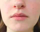 Primo piano del viso con labbra e naso. Si nota una leggera dermatite intorno al naso, con arrossamenti e piccole imperfezioni.