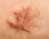 Cicatrice cheloide in rilievo sulla pelle. Esplorare i possibili rimedi per attenuarla.