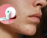 Czy pasta do zębów wysusza pryszcze? Dermatolog obala mit!