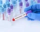 Podwyższona homocysteina: Co oznacza i jak ją skutecznie obniżyć?