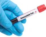 Rękawiczka w niebieskiej rękawiczce trzyma probówkę z napisem "Homocysteine Test". Wynik badania homocysteiny w normie.