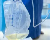 Worek na mocz z widocznym płynem i miarką. Zastanawiasz się, dlaczego mocz leci obok cewnika? Może to być problem z jego umiejscowieniem lub drożnością.