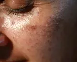 Gros plan sur la peau du visage, montrant des taches brunes. Des conseils sur comment enlever les taches brunes sur le visage pourraient être utiles.