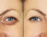 Antes y después de un tratamiento para cómo quitar las ojeras. Se observa una mejora notable en la zona debajo del ojo.