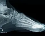Radiographie latérale du pied montrant une épine calcanéenne, indiquant la nécessité d'une prise en charge adaptée.